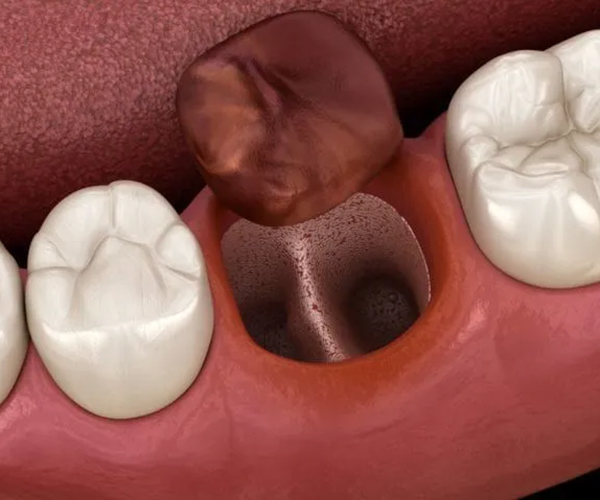 ドライソケットの原因は何ですか？